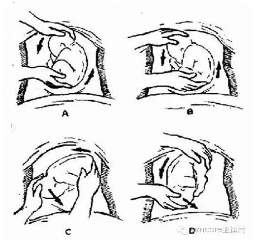 臀位剖宫产的步骤图片图片